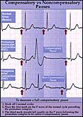 ecg_compens.gif